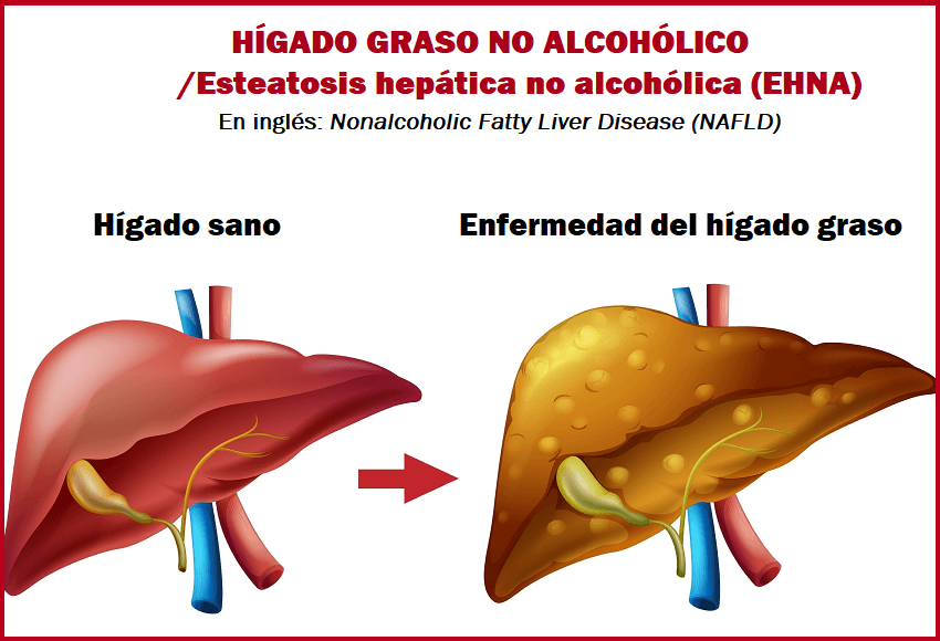 HÍGADO GRASO NO ALCOHÓLICO. ( Información para Pacientes).