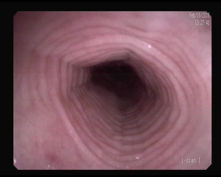 Esofagitis Eosinofilica.