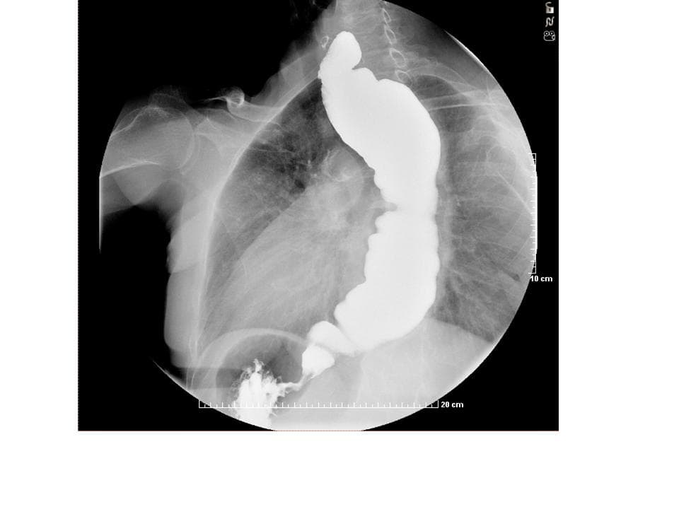Achalasia.