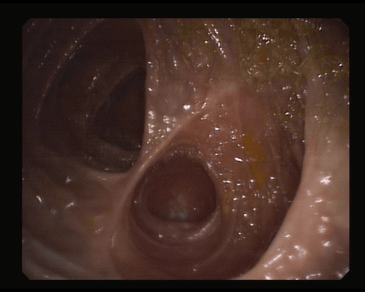 Anastomosis Ileo-cólica.