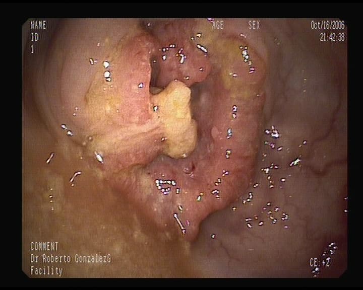 Cáncer de colon.