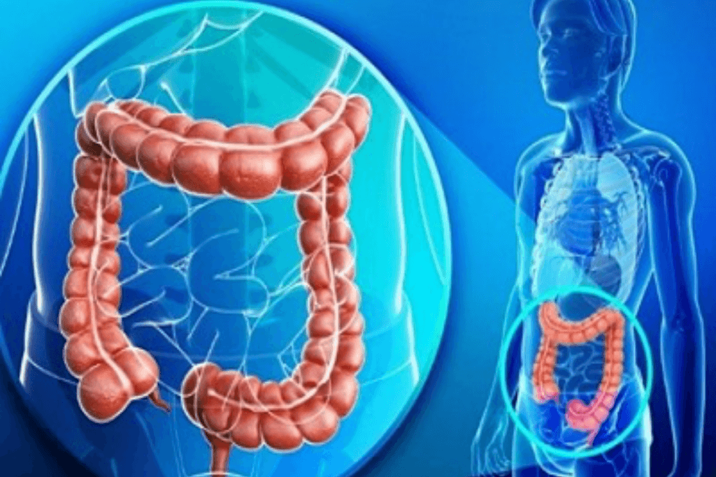 SEÑOR IRRITADO.-Colon Irritable