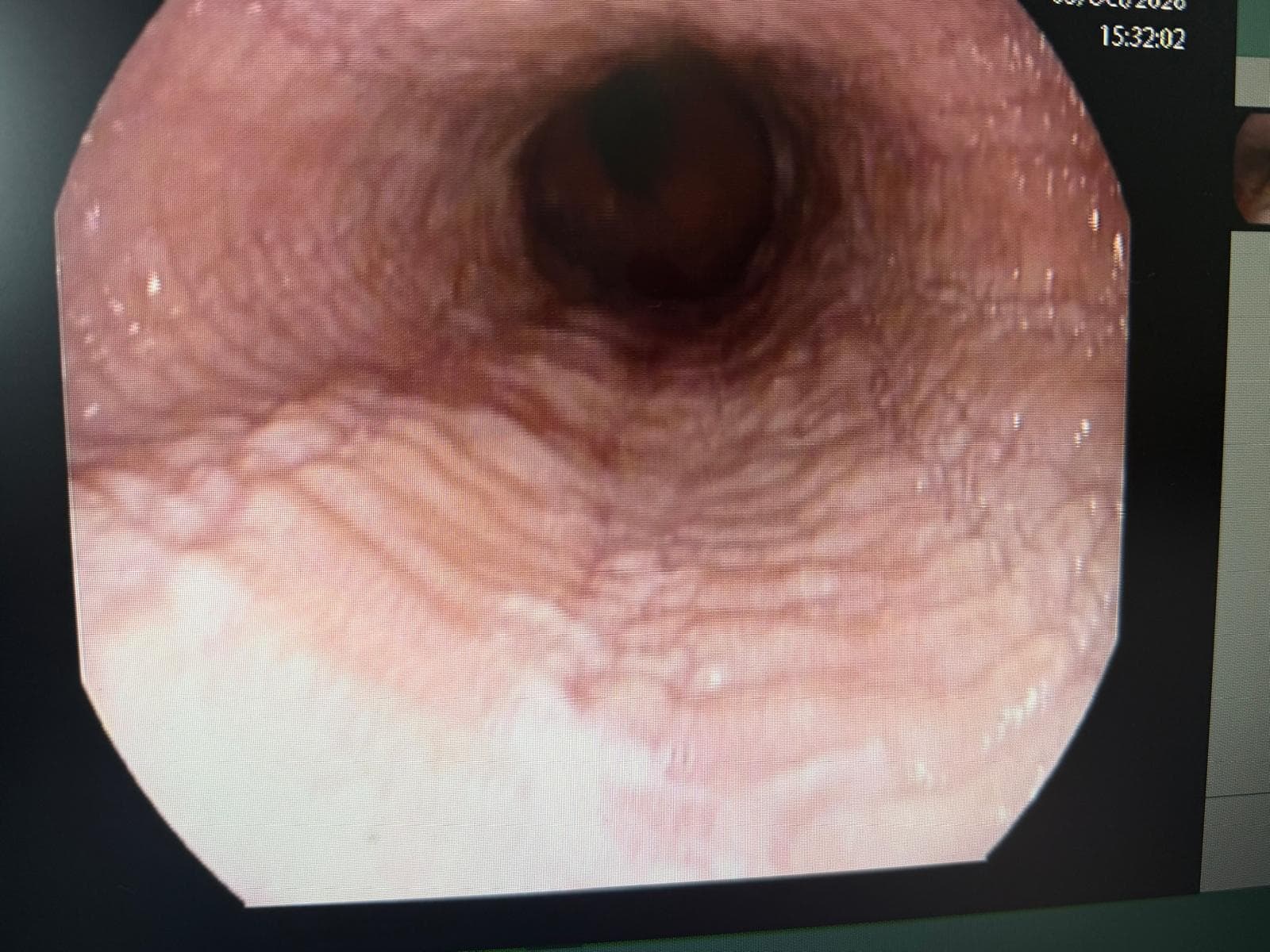 Esofagitis Eosinofílica.2