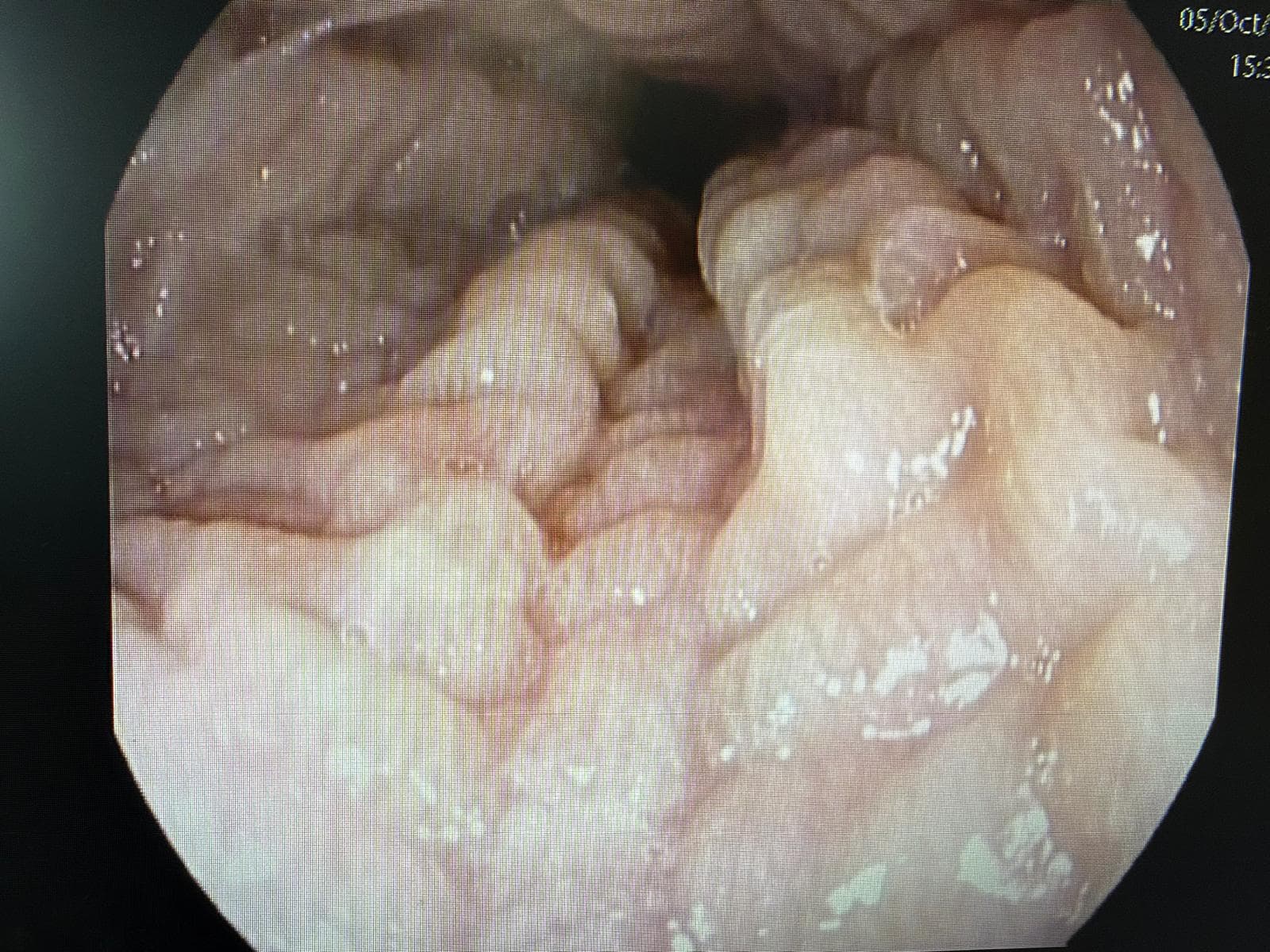 ESofagitis Eosinofilica.