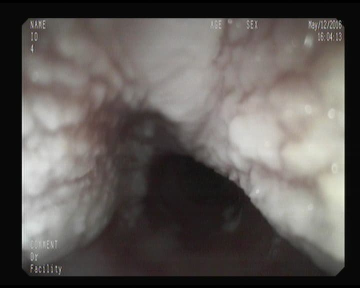 Esofagitis Micótica.