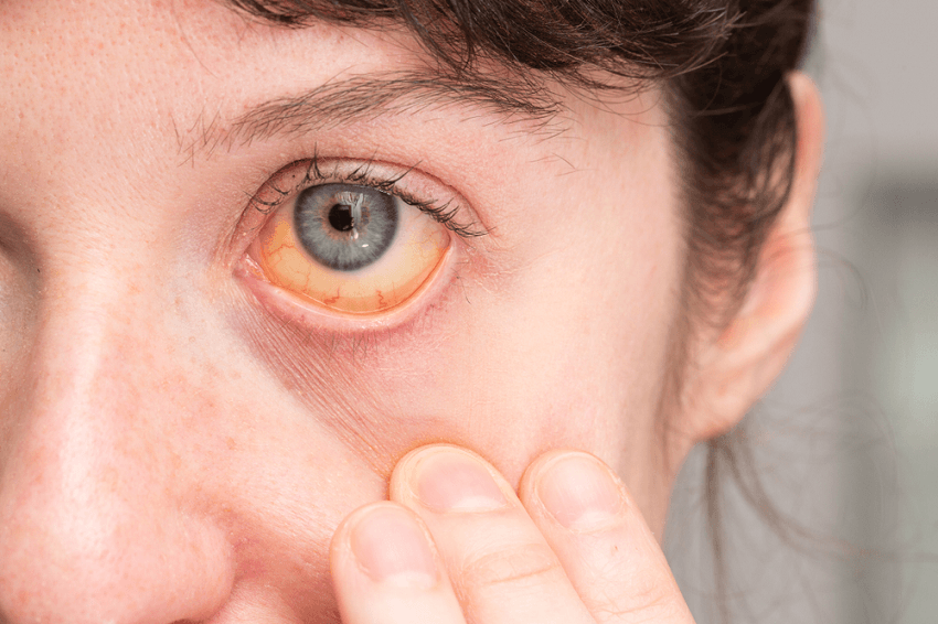 SINDROME DE GILBERT. Información para Pacientes.