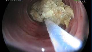 IMPACTACIÓN ALIMENTARIA. (Información para pacientes).