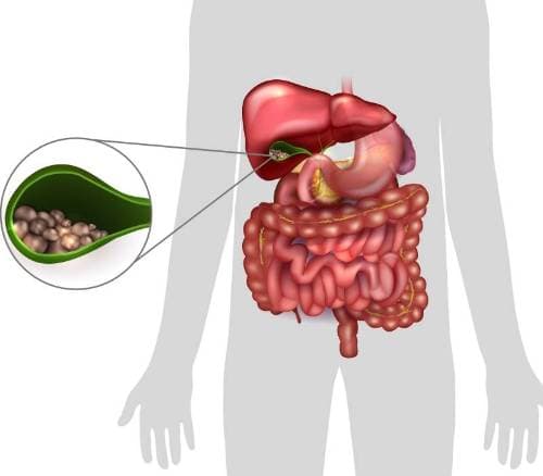 COLELITIASIS.- PIEDRAS EN LA VESÍCULA-COLELITIASIS. I- (Información para pacientes).