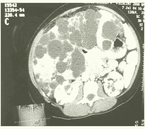Multiples quistes simples Hepaticos-.