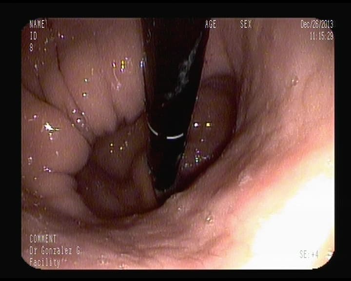 Hernia de Hiato.