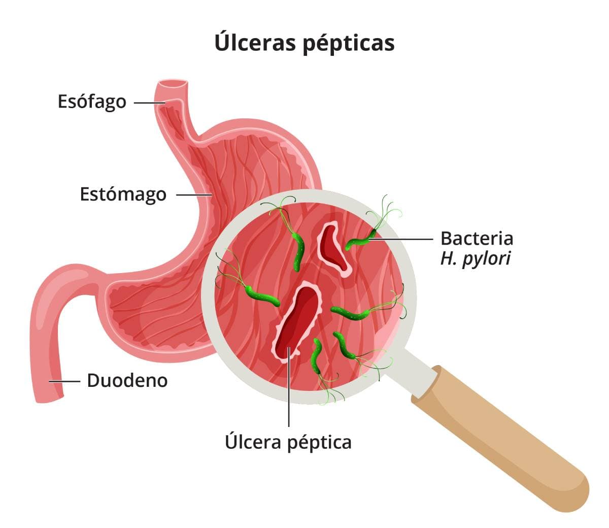 ÚLCERA GASTRO DUODENAL.( Información para Pacientes).