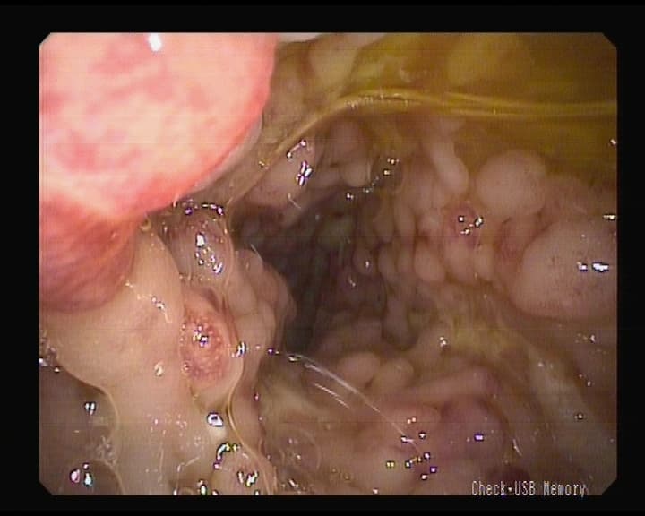 Enfermedad de Crohn.