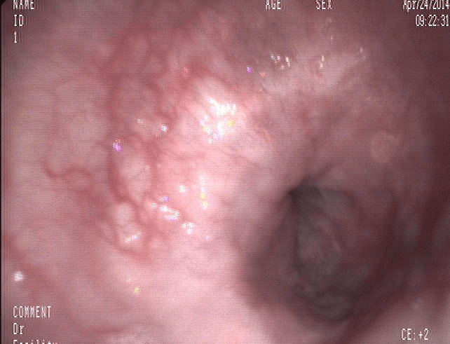 Línitis plástica- Cáncer Gástrico