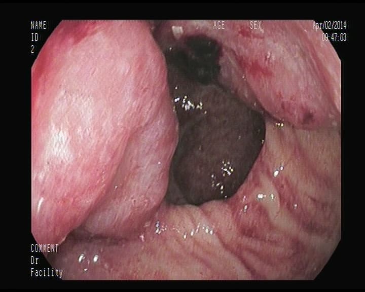 Cáncer Rectal.
