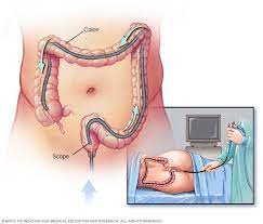 COLONOSCOPIA.