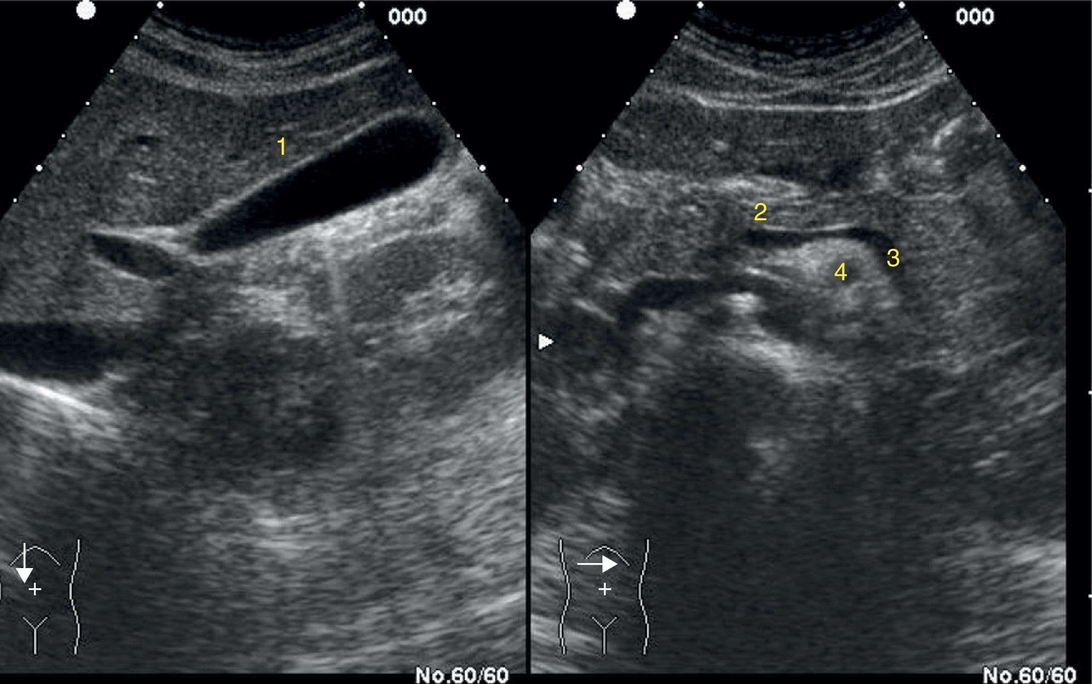 ECOGRAFIA ABDOMINAL-ULTRASONIDOS. ( Información para Pacientes)