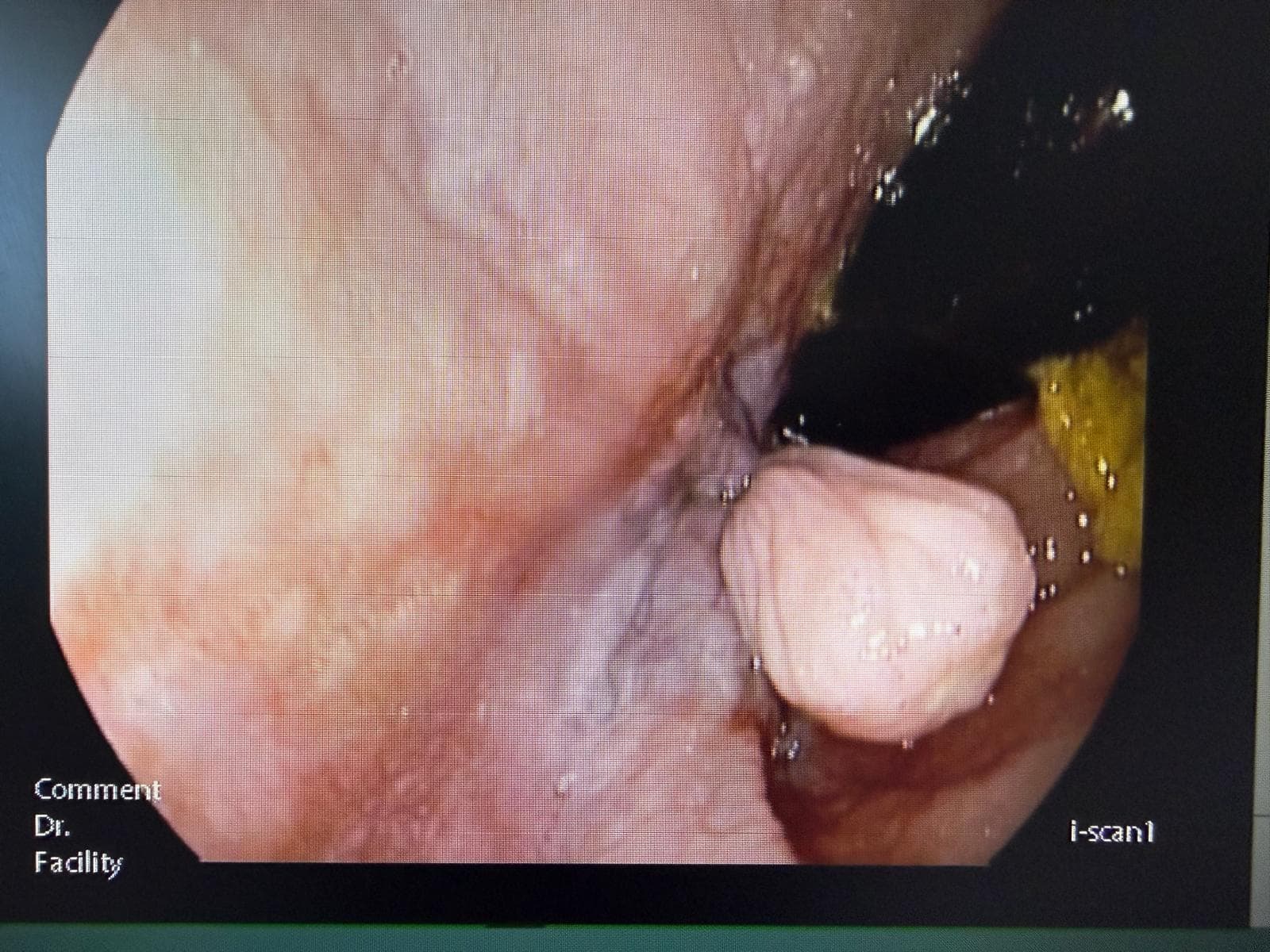 PÓLIPO FIBROIDE DE CANAL ANAL.