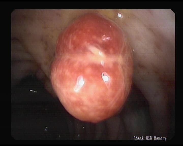 Polipo Adenomatoso. Benigno.
