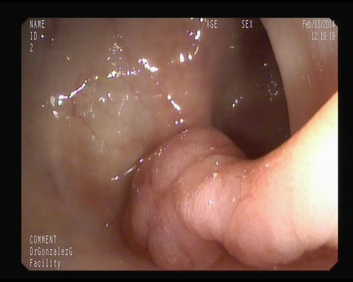 Pólipo con pedículo grueso y largo en Sigma.