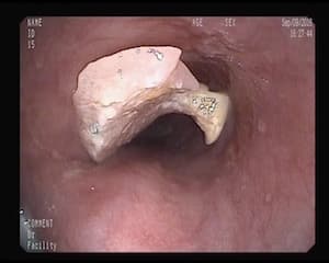 Prótesis Dental en Esofago.