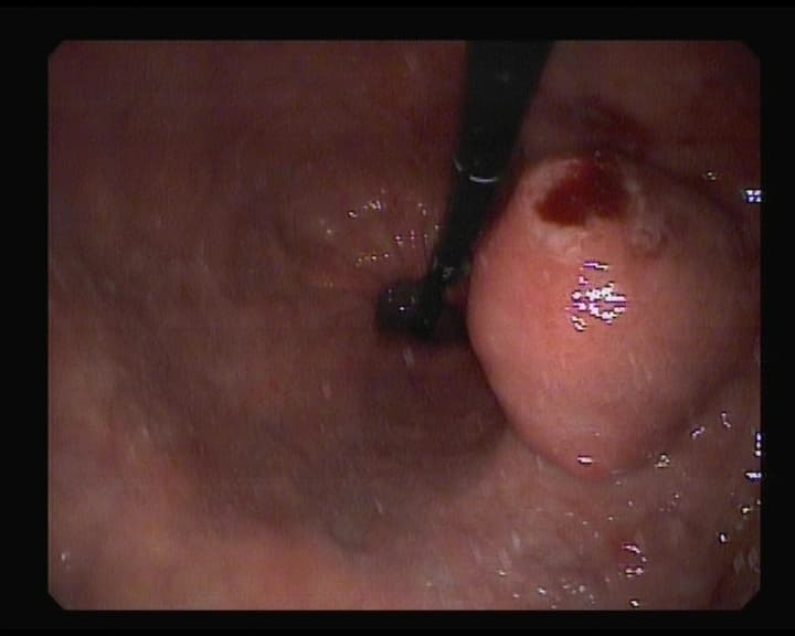 Tumor de GIST
