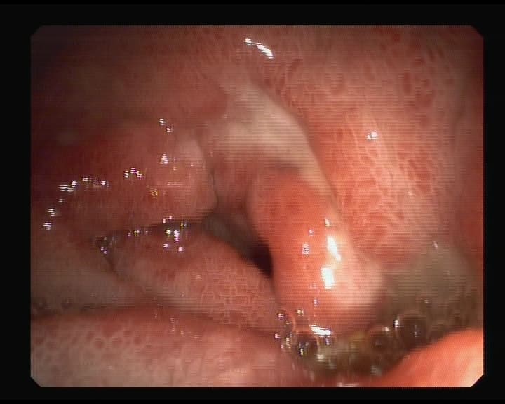 Úlcera Peptica Duodenal.