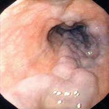 Varices Esofágicas.