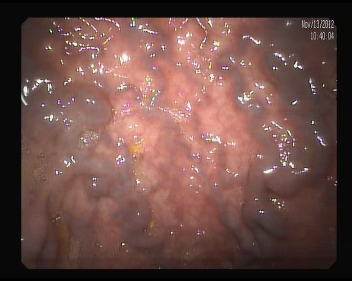 Varices rectales.